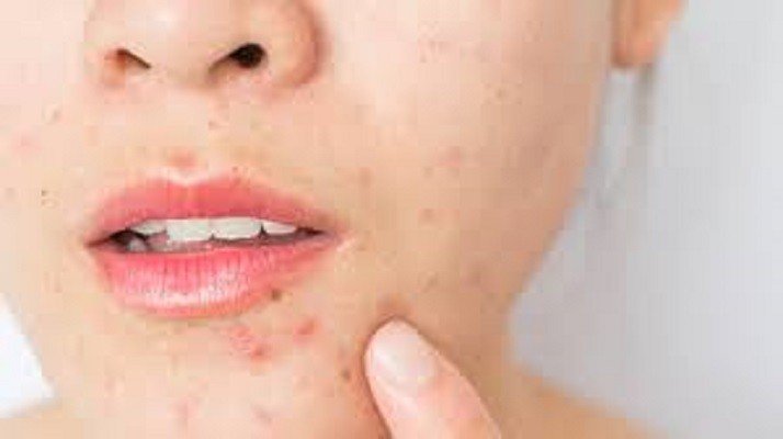 Dia do Adolescente: saiba o que as alterações hormonais causam na pele