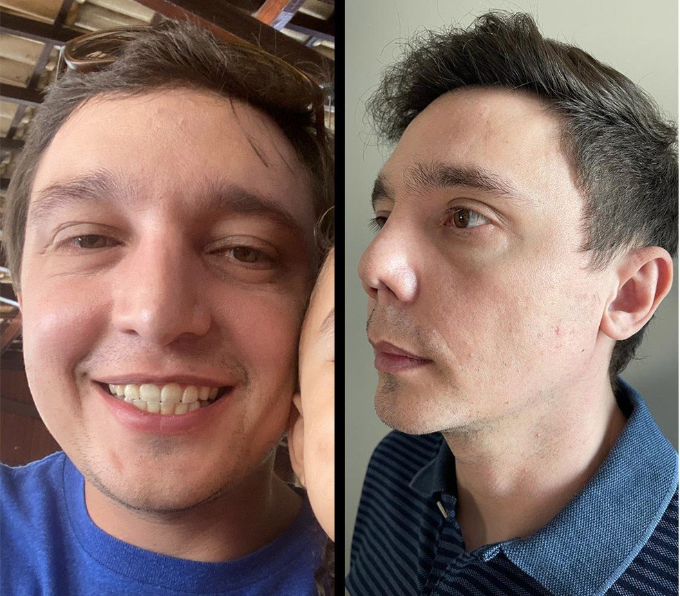 'Ele retalhou meu nariz', diz paciente do cirurgião plástico suspeito de prejudicar ao menos 30 pessoas