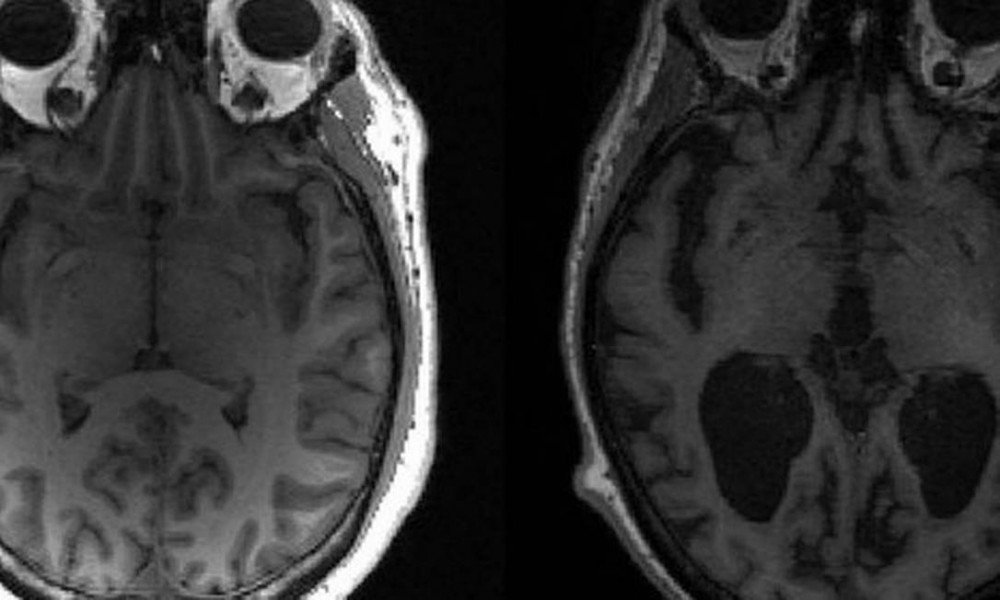 Achado brasileiro abre caminho para remédios capazes de evitar o Alzheimer