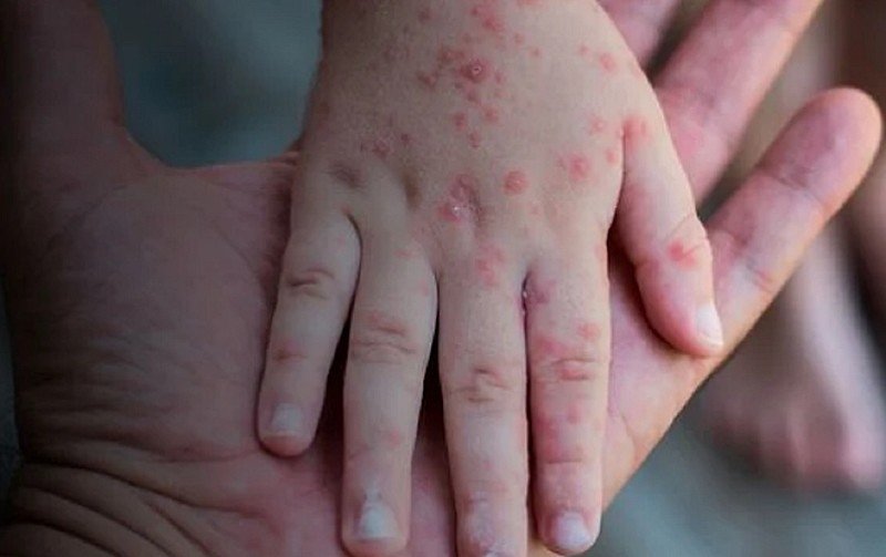 Varíola dos macacos no Brasil é ‘muito preocupante’, diz OMS