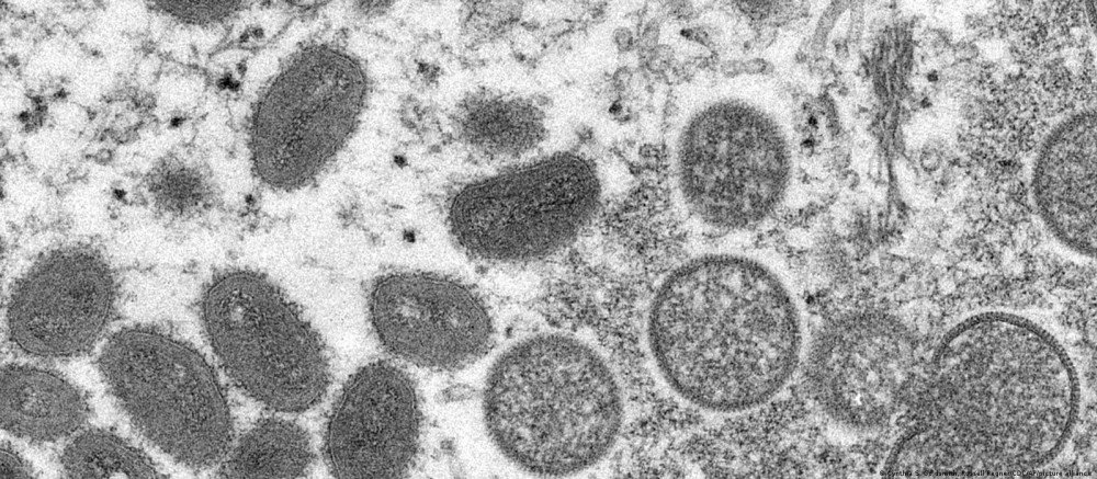 Brasil registra segunda morte por varíola dos macacos