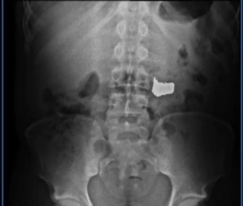 Em Salvador, suspeito é preso após engolir corrente de ouro roubada na Barra