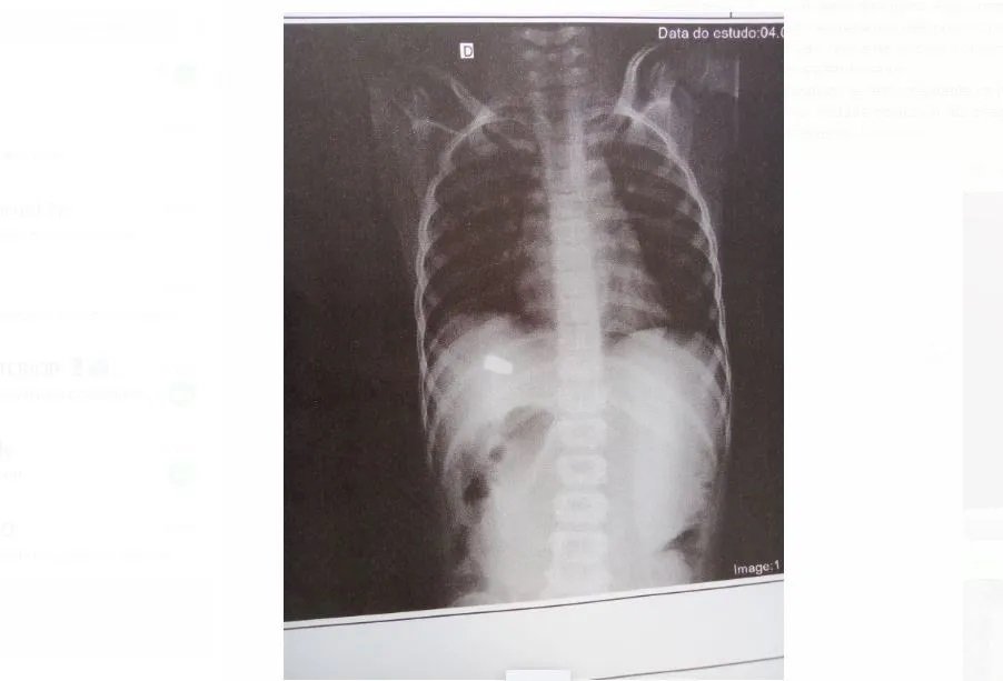 Em Salvador, criança é baleada enquanto brincava na casa da madrinha