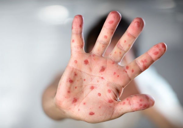 OMS alerta para aumento de casos de sarampo no mundo