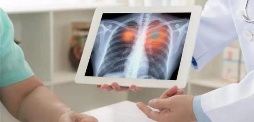 Fiocruz: casos de síndrome respiratória aguda grave aumentam no Brasil no país