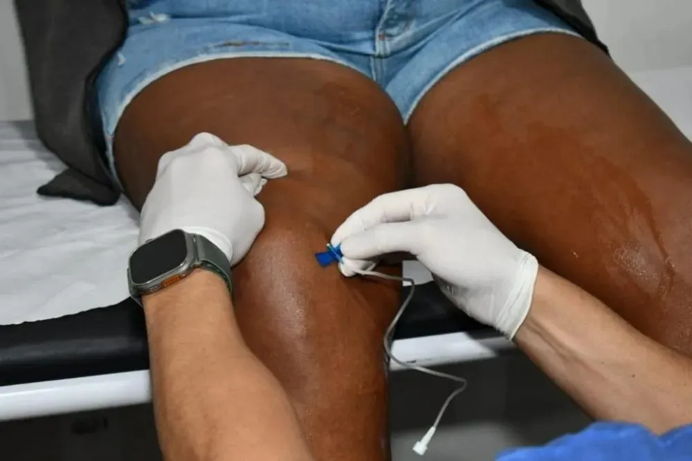 Alagoinhas: Segunda etapa do mutirão de cirurgias de varizes