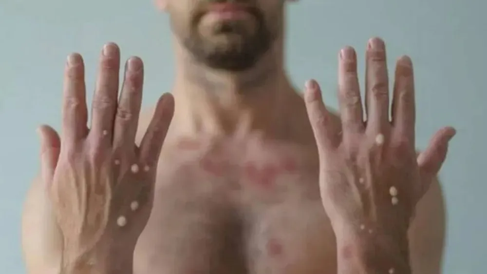 Varíola mpox: Bahia contabiliza 38 casos ao longo de 2024