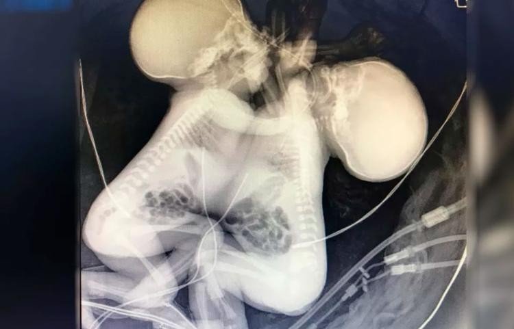 Siamesas baianas nascidas unidas pelo coração morrem em hospital de Goiânia
