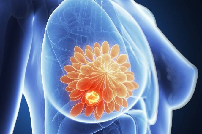 Novo tratamento para câncer de mama adia quimioterapia por até 4 anos