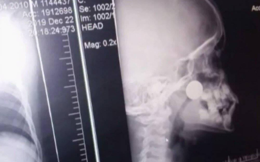 Menino fica dois dias com moeda presa dentro do nariz