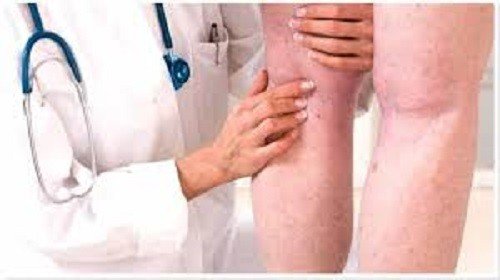 Falta de exercícios aumenta risco de trombose durante isolamento social