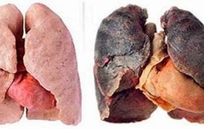 Mais uma sequela da pandemia: aumento no consumo de cigarro alerta para o câncer de pulmão