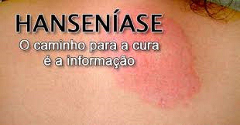 Brasil enfrenta desabastecimento de remédios de hanseníase e entidades dizem que governo ignora alertas há mais de um ano